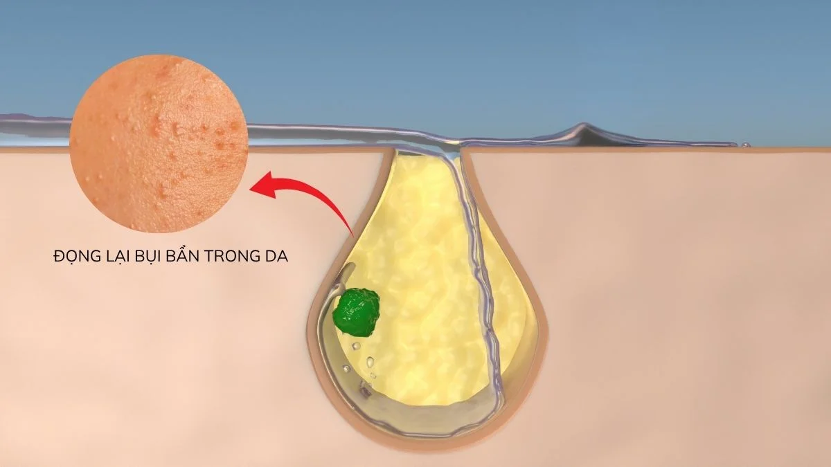 Hậu quả bít tắc lỗ chân lông