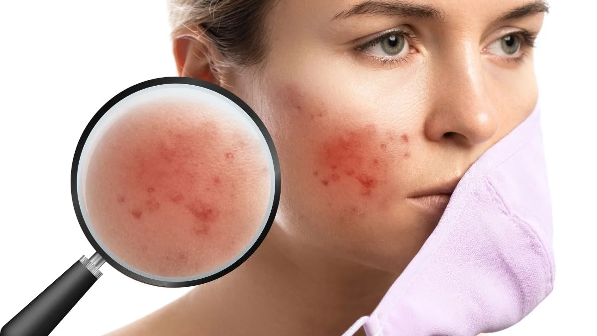 Gây kích ứng mẩn đỏ nghiêm trọng