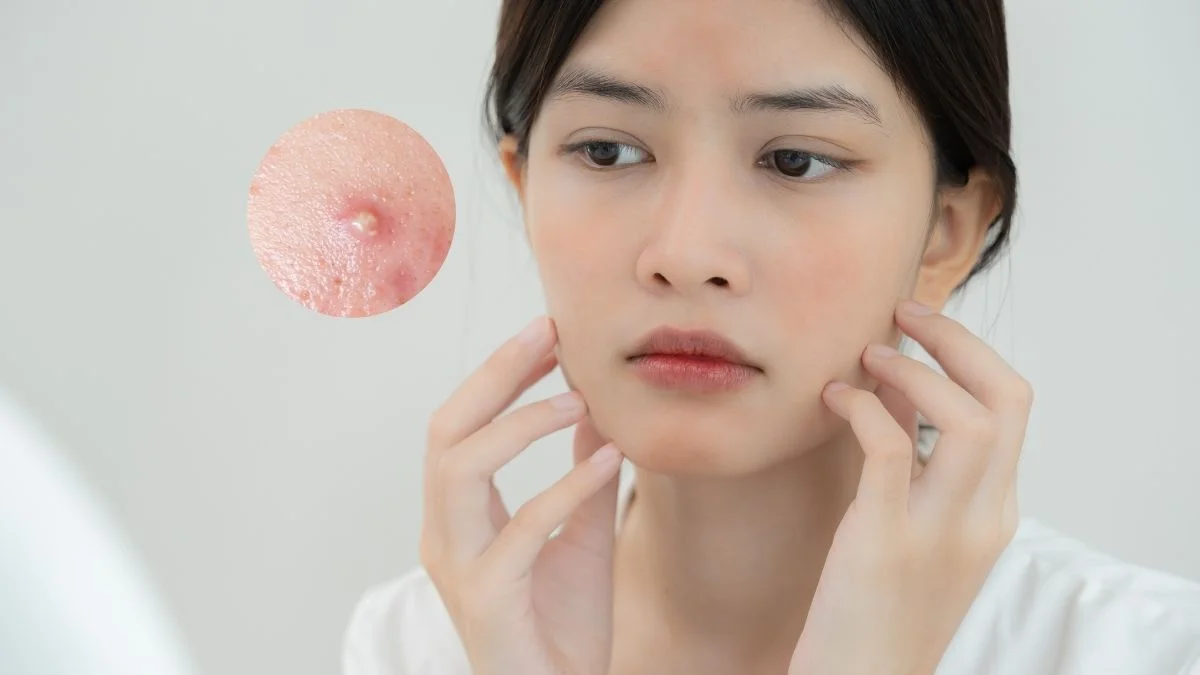 Dễ nổi mụn ảnh hưởng đến thẩm mỹ