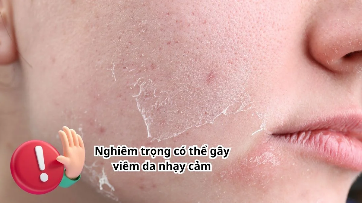 Có thể gây viêm da nhạy cảm